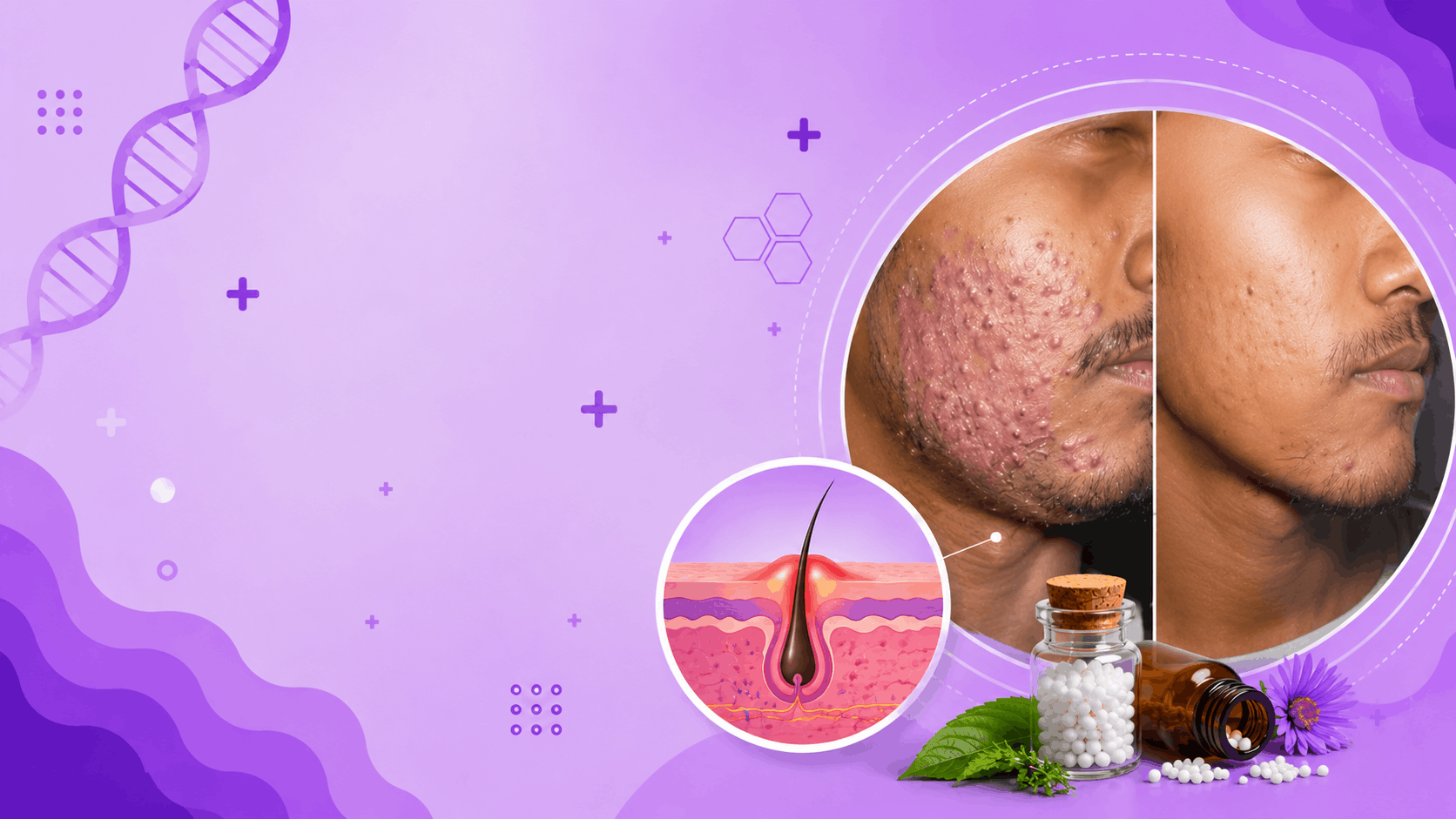 Acne Banner