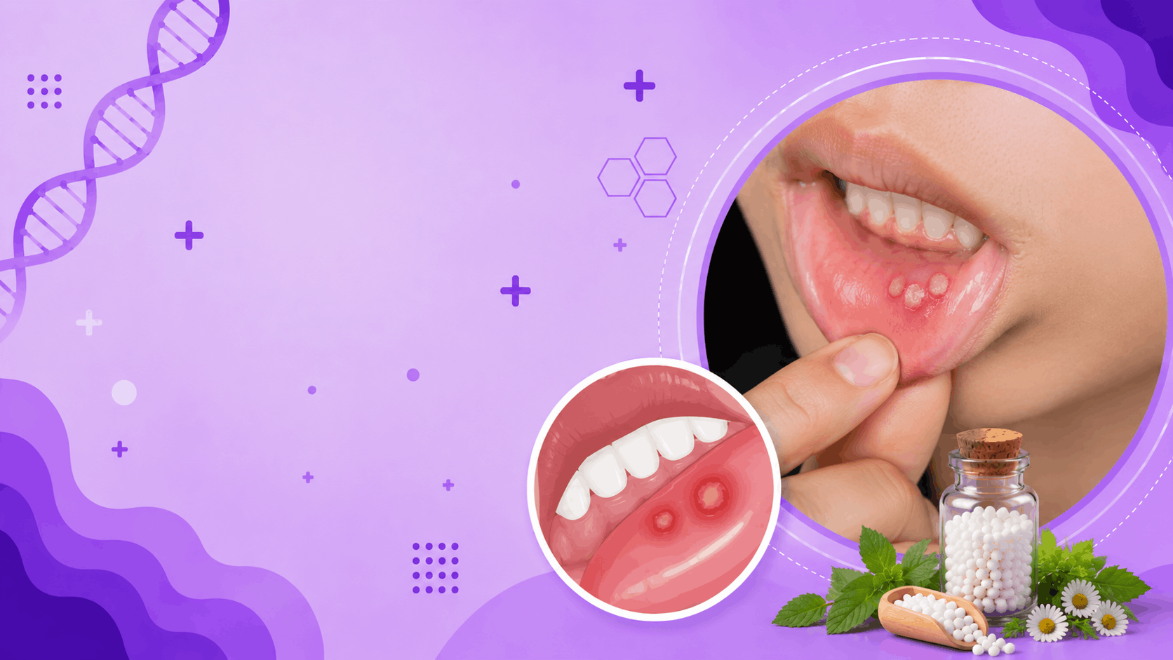 Aphthous Ulcer Banner
