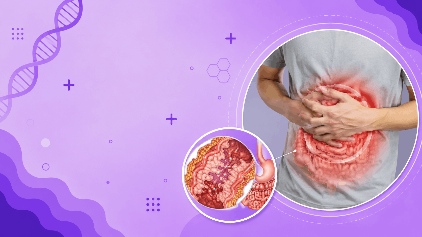 Crohn’s disease Banner