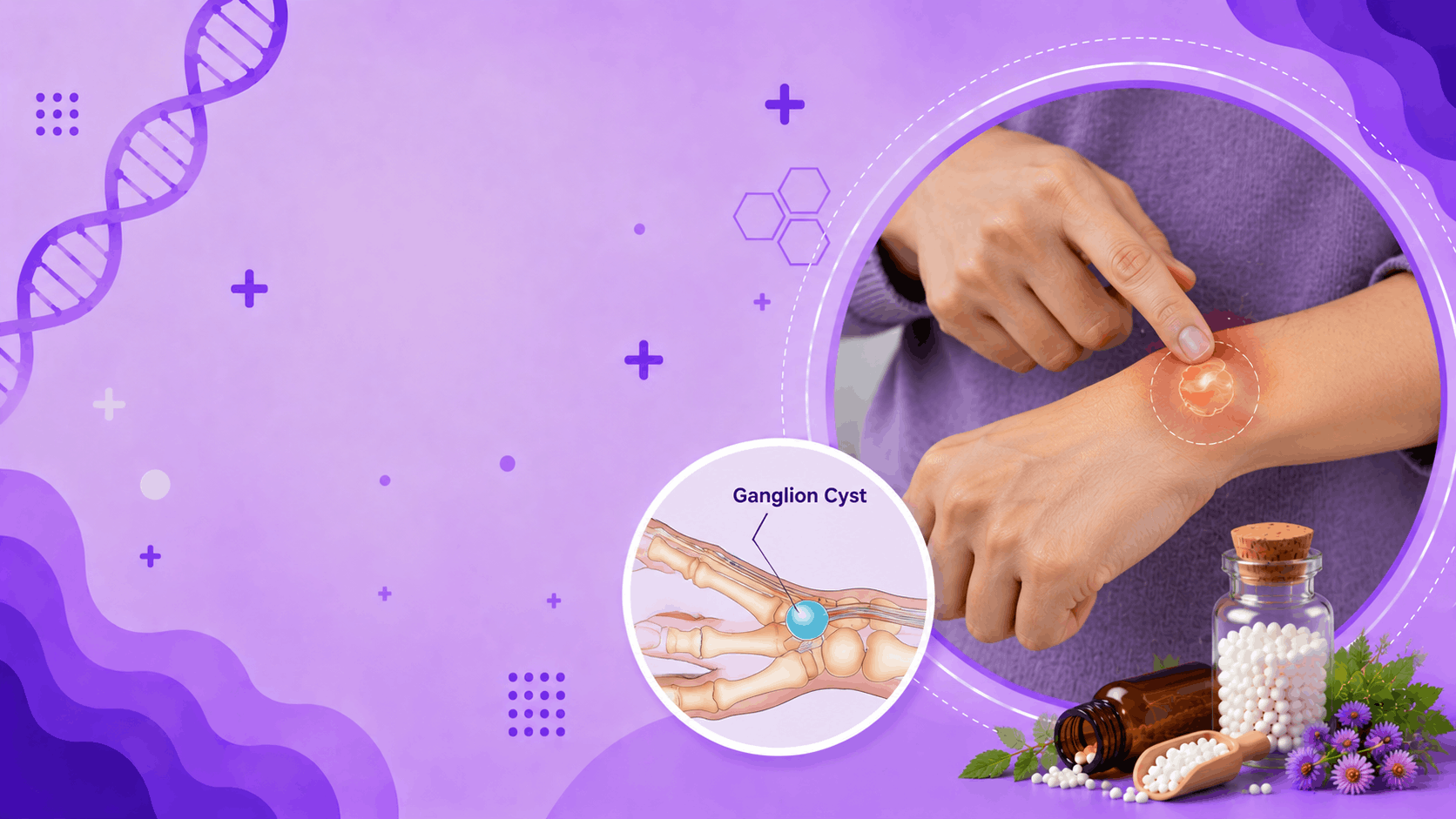 Ganglion cyst Banner
