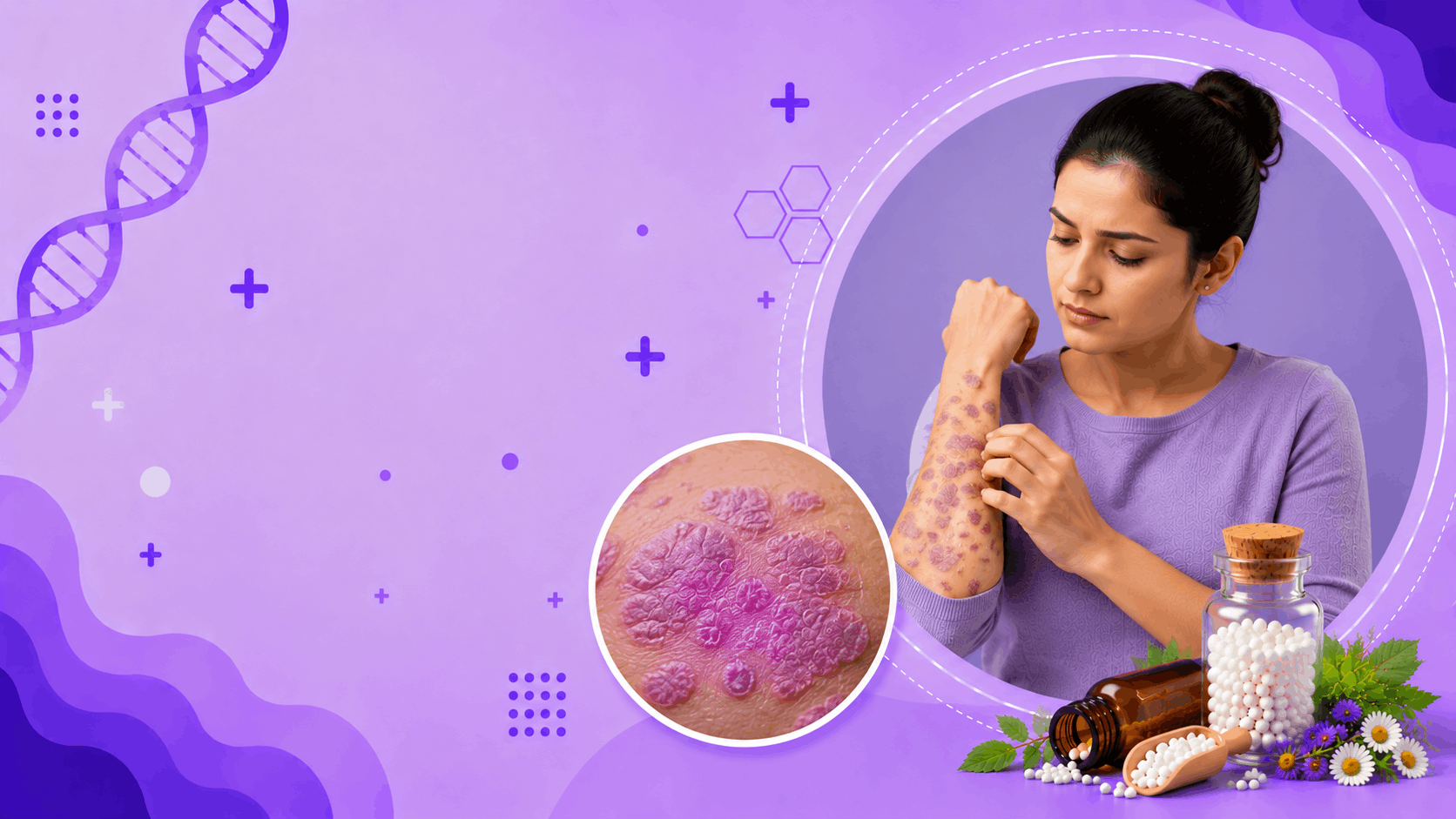 Lichen Planus Banner