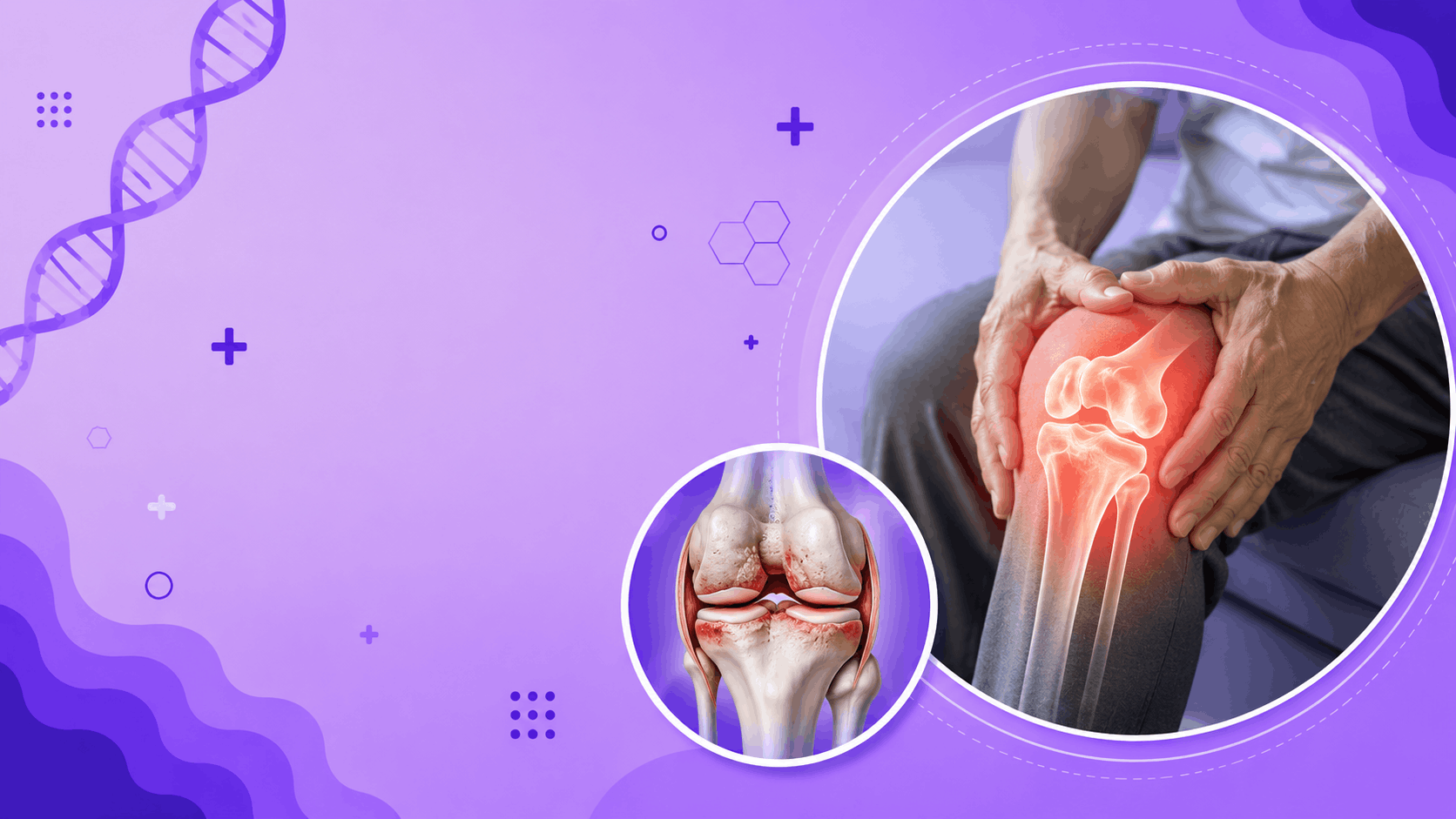 Osteoarthritis Banner